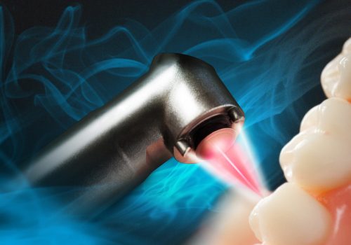 Laser-Dentistry-in-magarpatta.jpg