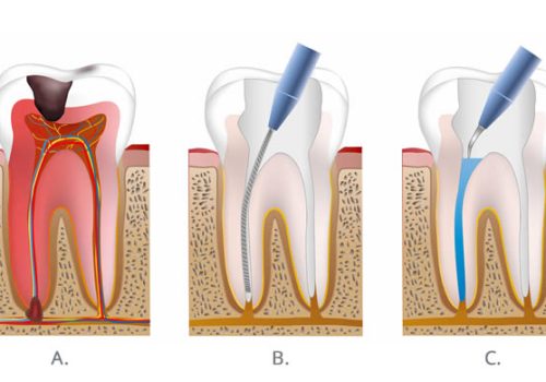 root-canal-in-magarpatta.jpg