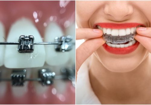 teeth-whitening-braces-invisalign.jpg