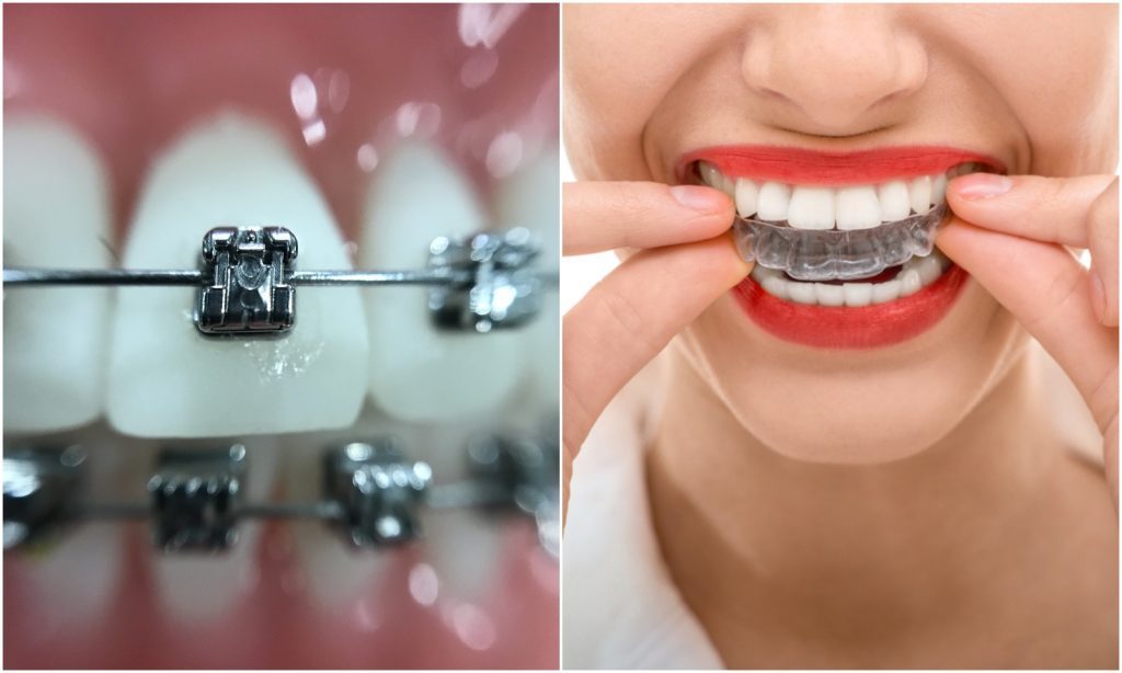 Braces and invisalign Treatment in Koregaon Park, Kalyani Nagar Pune