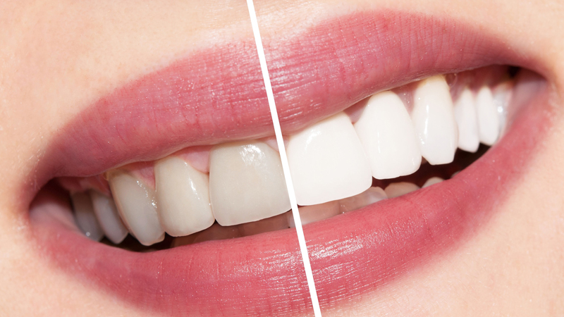 Teeth Whitening Treatment in Magarpatta