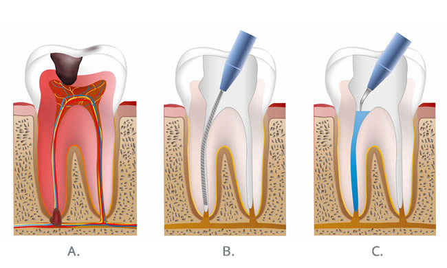 Root Canal Treatment in Magarpatta