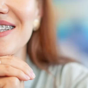 Life with Braces: Tips for Managing Orthodontic Treatment